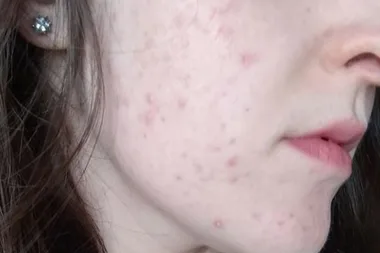 Woman is DUMPED after taking off makeup and revealing her acne