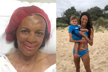 Turia Pitt: ‘I lost friends after the fire’