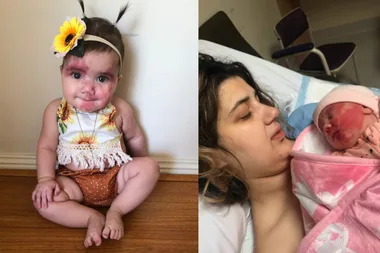 Trolled online for her birthmark – but baby Angelica will never stop smiling