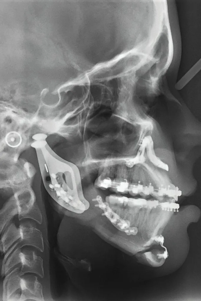 My 3D-printed jaw