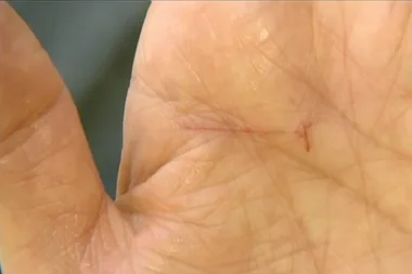 Stung by a deadly fish