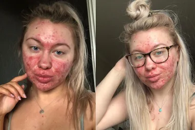 Teenager with severe acne shares makeup-free photos – admitting she spends hours covering her blemishes