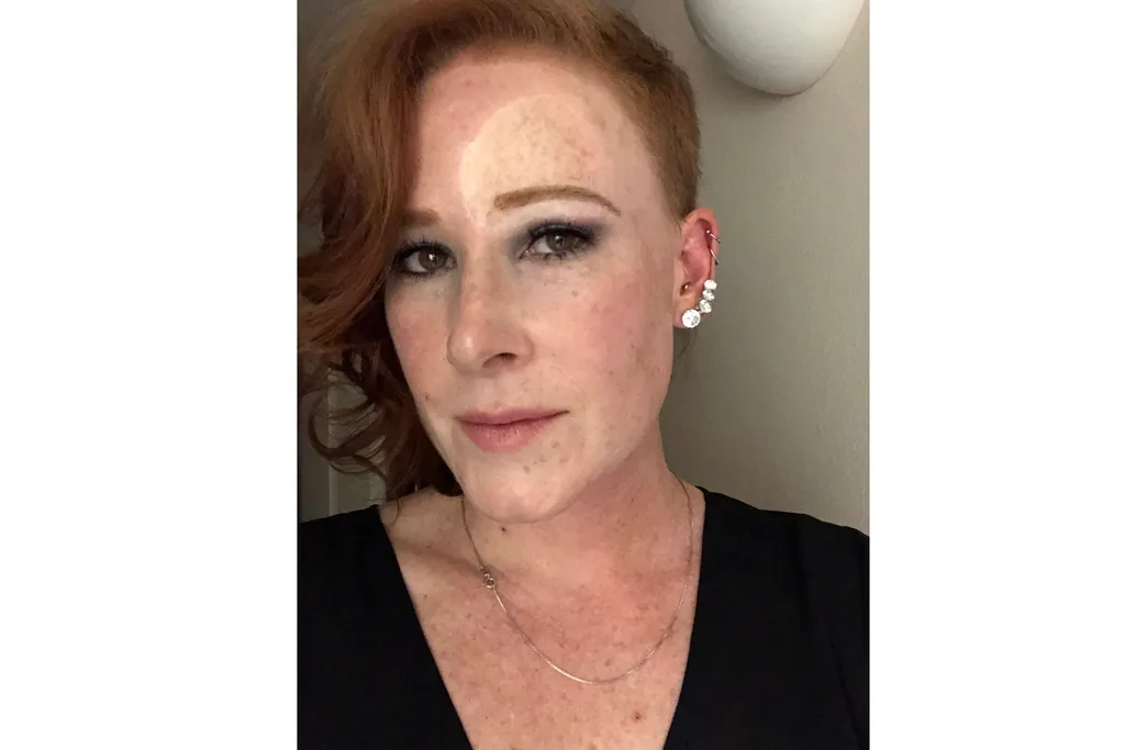 She wants to warn others about the dangers of sunburn