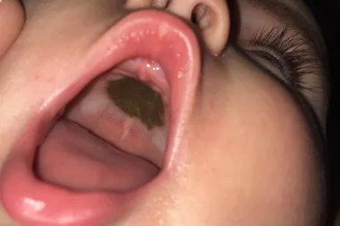 Mum baffled by mystery mark in daughter’s mouth – but can you tell what it is?