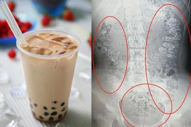 CT scan shows hundreds of tapioca balls from bubble tea stuck inside 14-year-old girl’s stomach