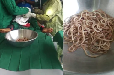 Surgeons discovered hundreds of worms inside a four-year-old boy