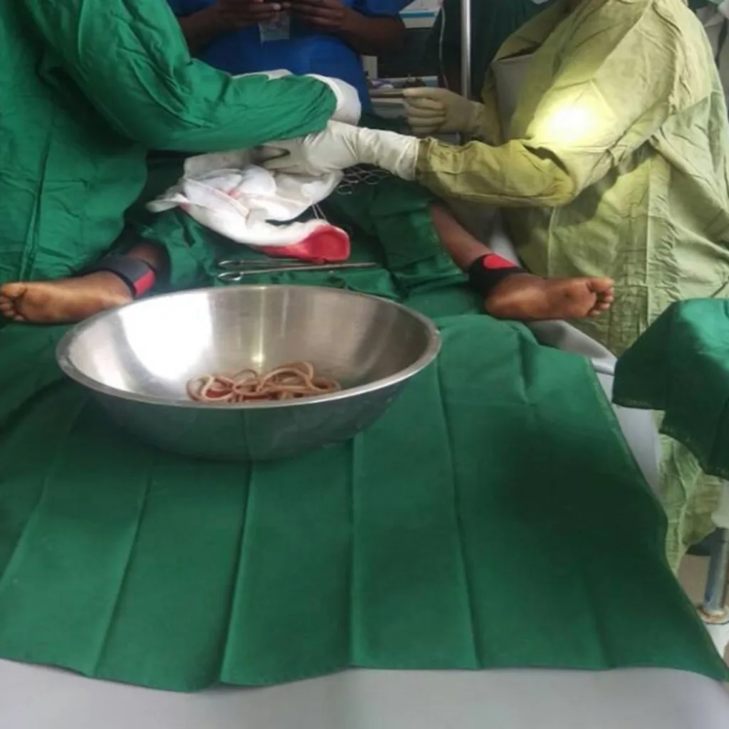 The surgeons removed the parasites.