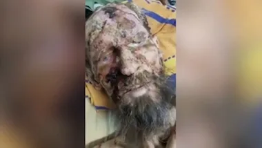 WARNING Graphic content: Man looks like mummy after being rescued from bear den