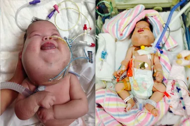 Girl born with THOUSANDS of cysts on her face has revolutionary surgery