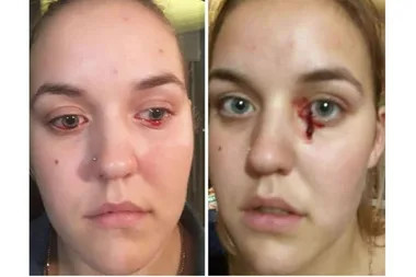 Aussie woman’s eyes won’t stop BLEEDING