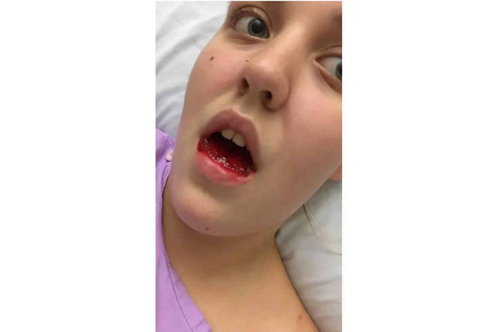 Alexis bleeding from the mouth