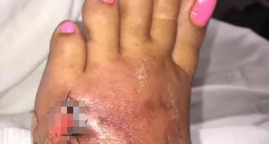 Woman gets flesh-eating bug after dip in the sea