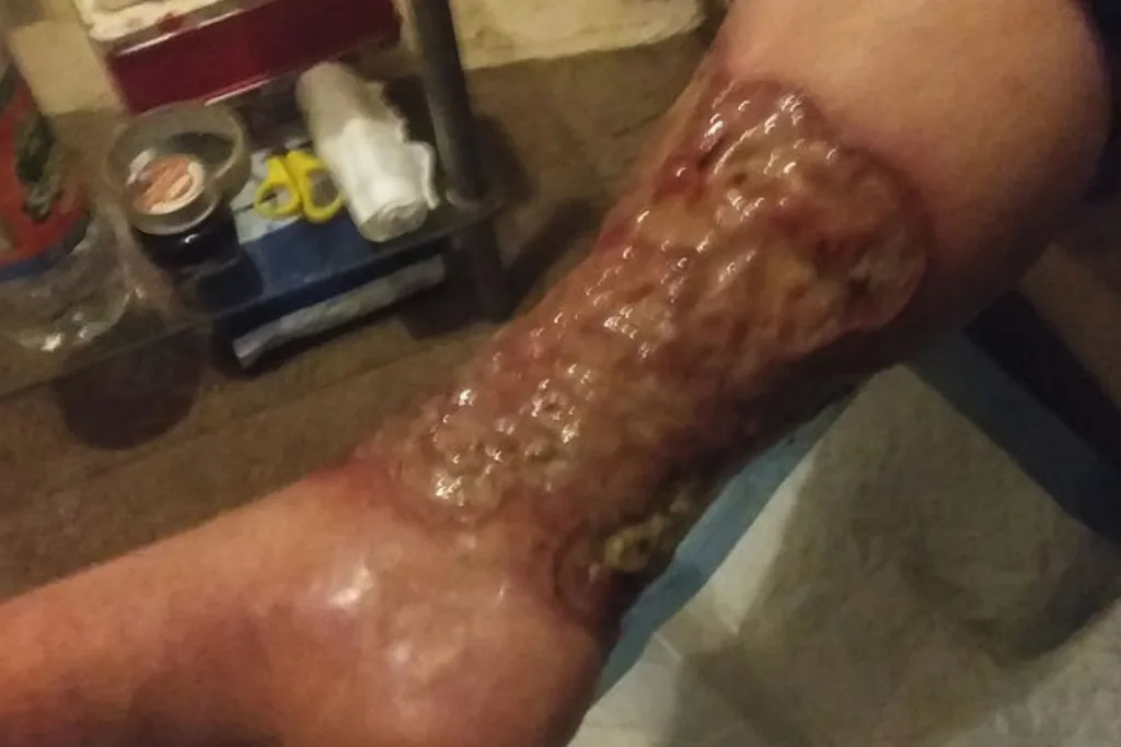 Infected leg