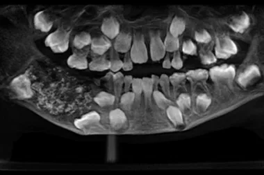 More than 500 TEETH surgically removed from seven-year-old boy’s mouth