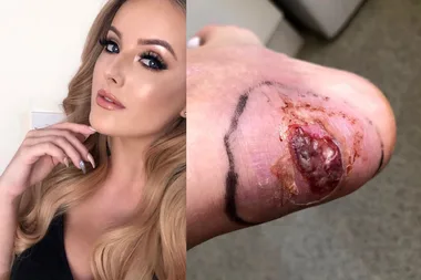 Woman lucky to be alive after contracting SEPSIS from her high heels