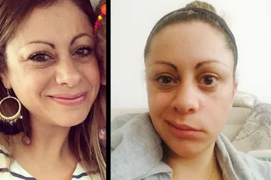 Giving birth made my face collapse