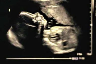 Boyfriend tries to force mum to terminate when they discover baby has no limbs