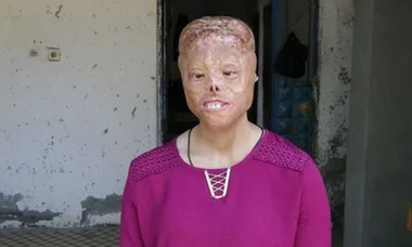 Burned alive as a baby, now she is set to receive a new face
