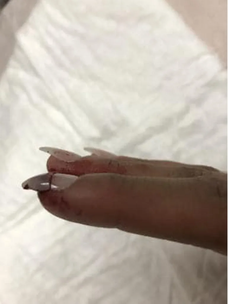They removed the whole nail