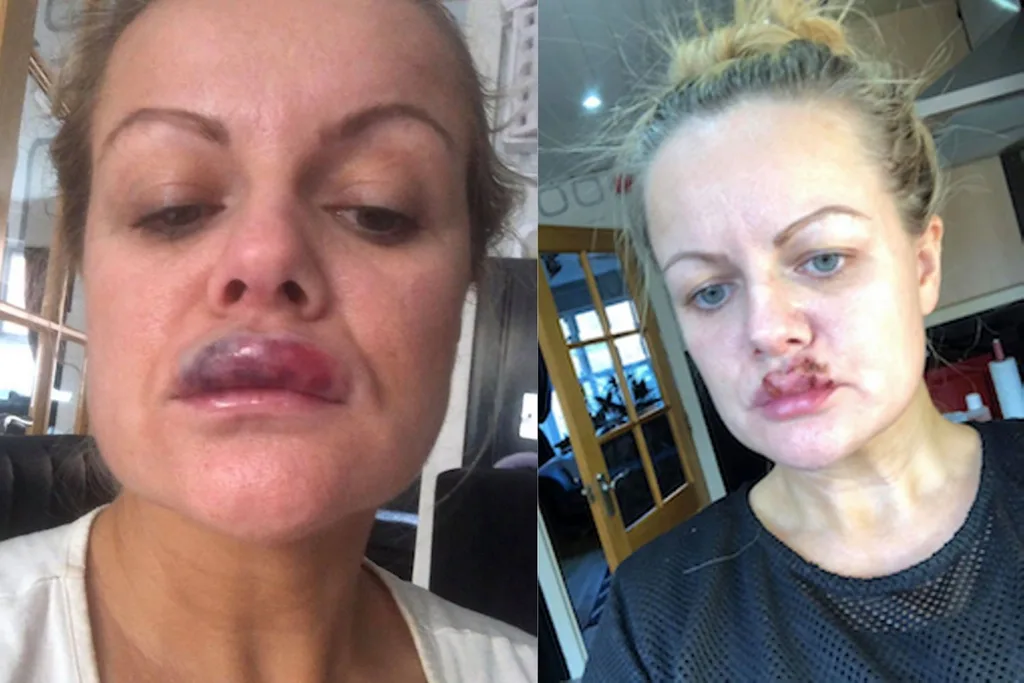 Lindsay Collins lip job botch