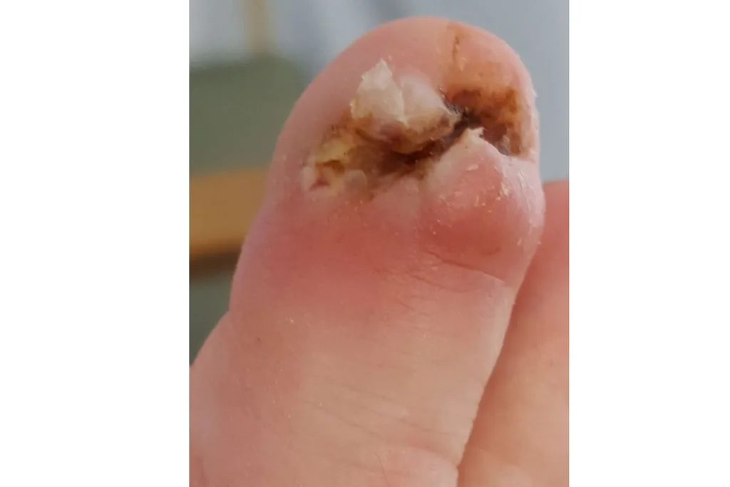 The infected toe