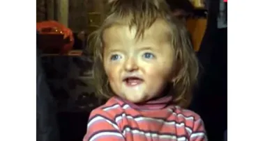 Girl, 2, is BANNED from daycare because of her deformed skull