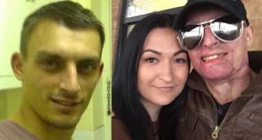 Daniel was savagely doused in acid by his exil ex…but then found love again