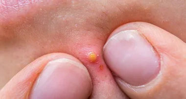 How a popped pimple caught a cheating husband!