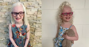 Aussie mum: Don’t stare at my Albino girls!