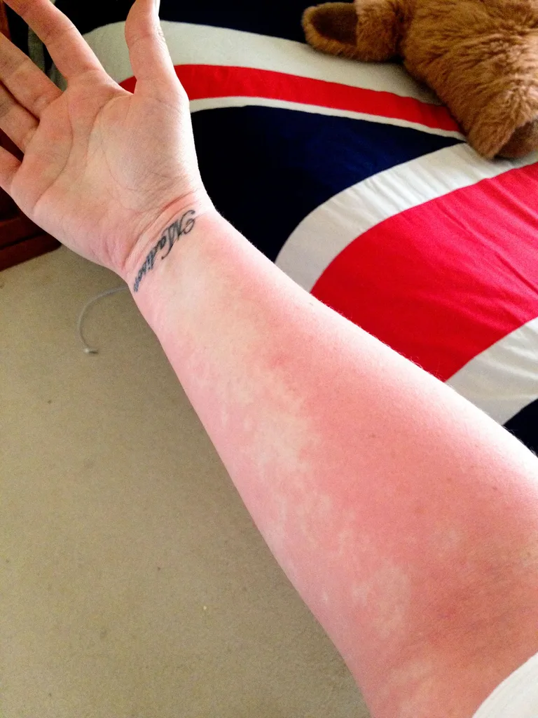 The rash coming on.