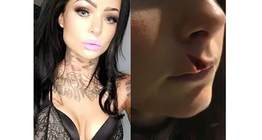 Scarred for life by a plastic cup