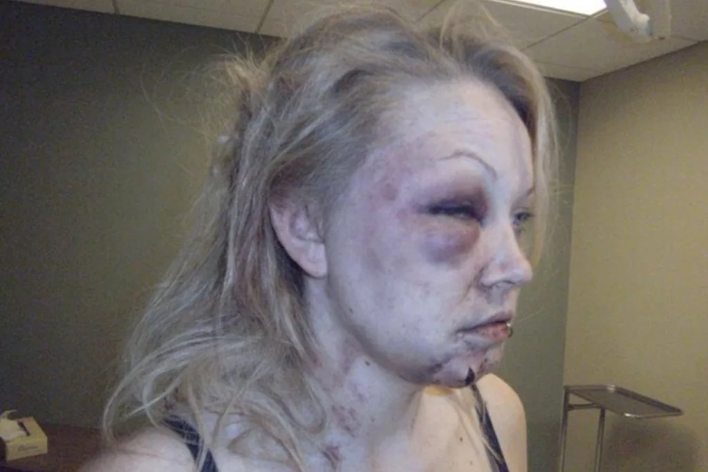 Jenna Schiller's injuries