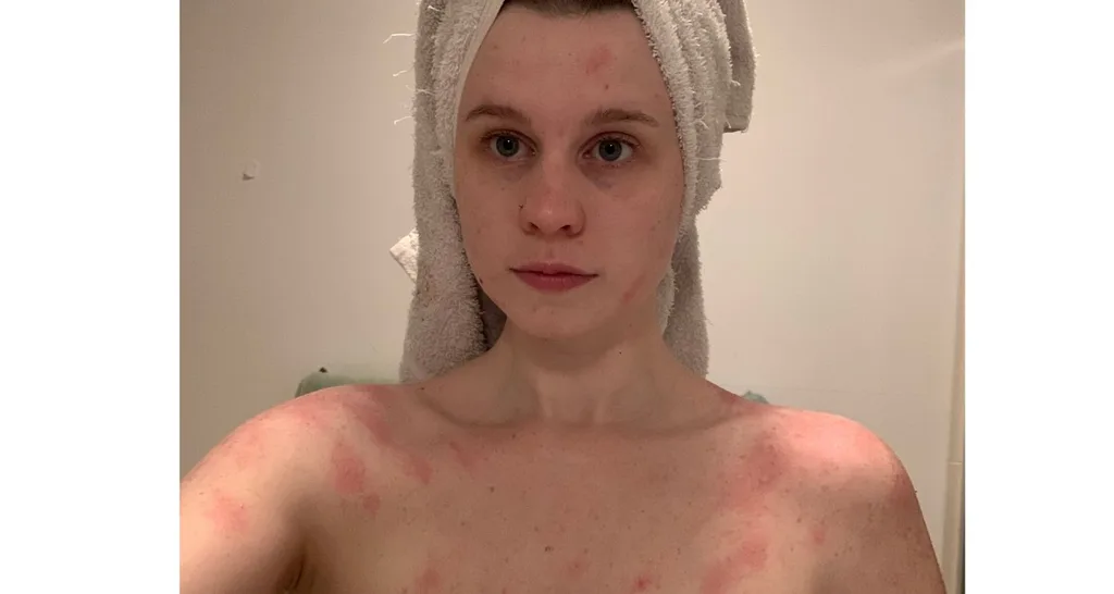 Alex Mackay's water allergy