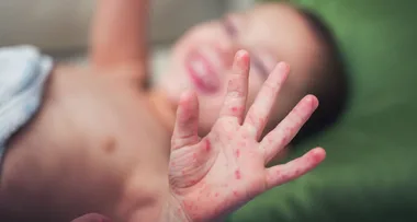 Warning over measles after infected woman diagnosed with contagious virus