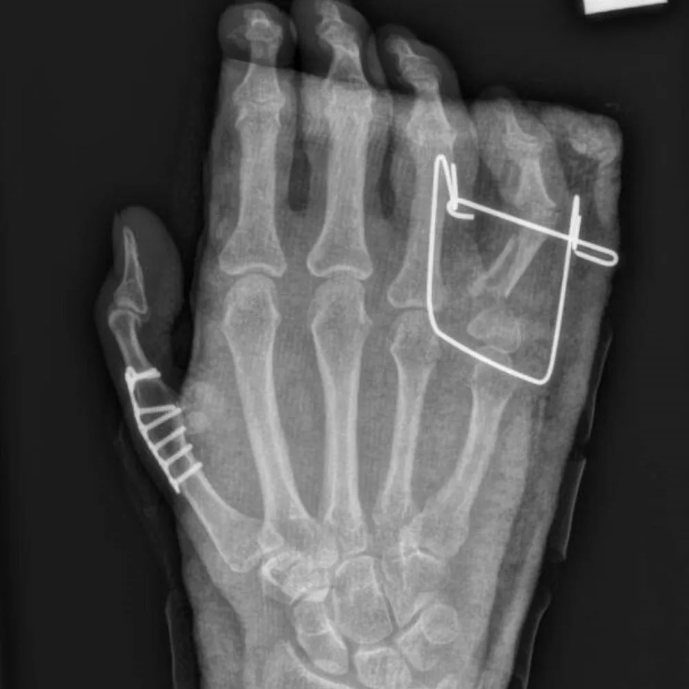 Juanita's finger and thumb were crushed by the fishing line. Credit: Supplied