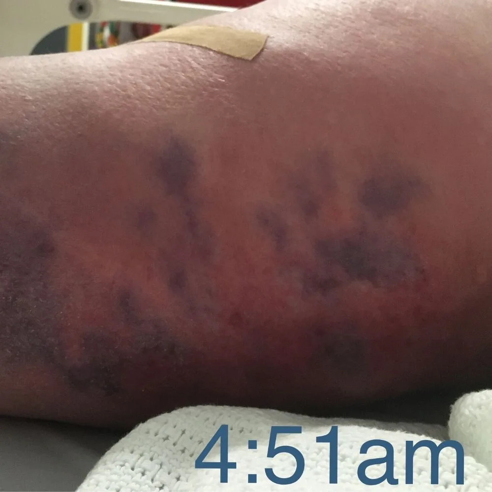 Black spots appeared all over my leg.