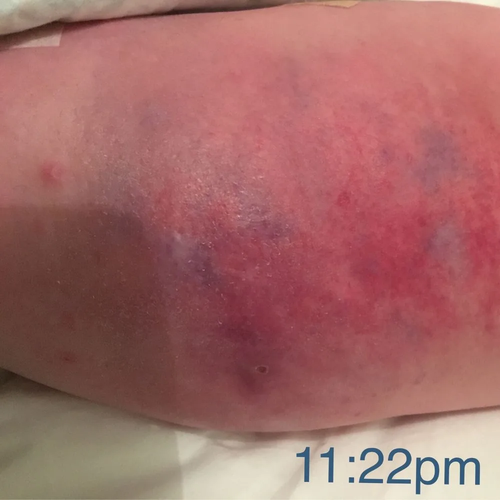Soon my leg was swollen and red.