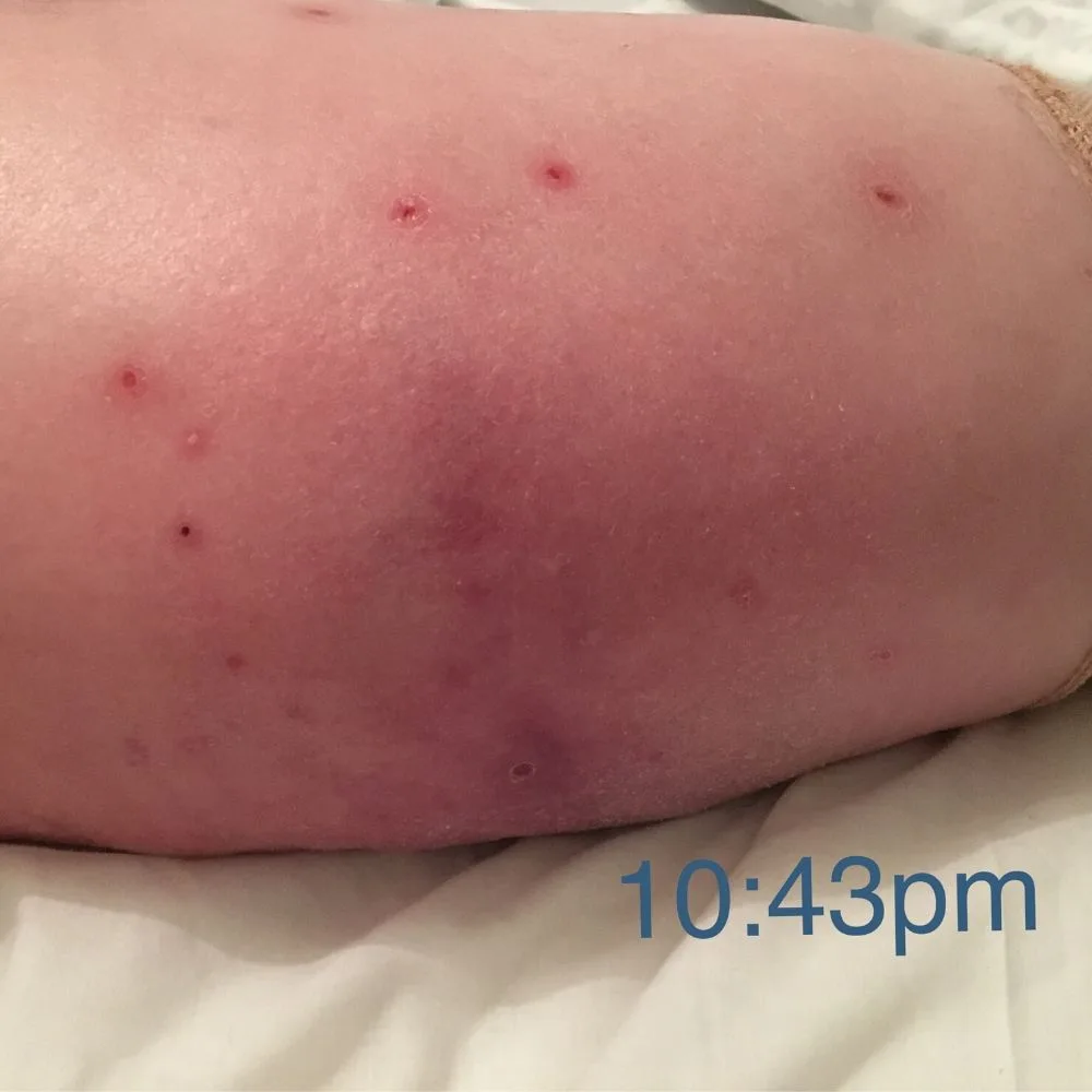 It started with itchy lumps