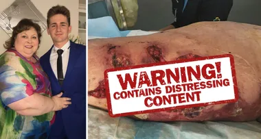 SHOCK PICS: A FLESH-EATING bug almost cost this Aussie mum her leg!