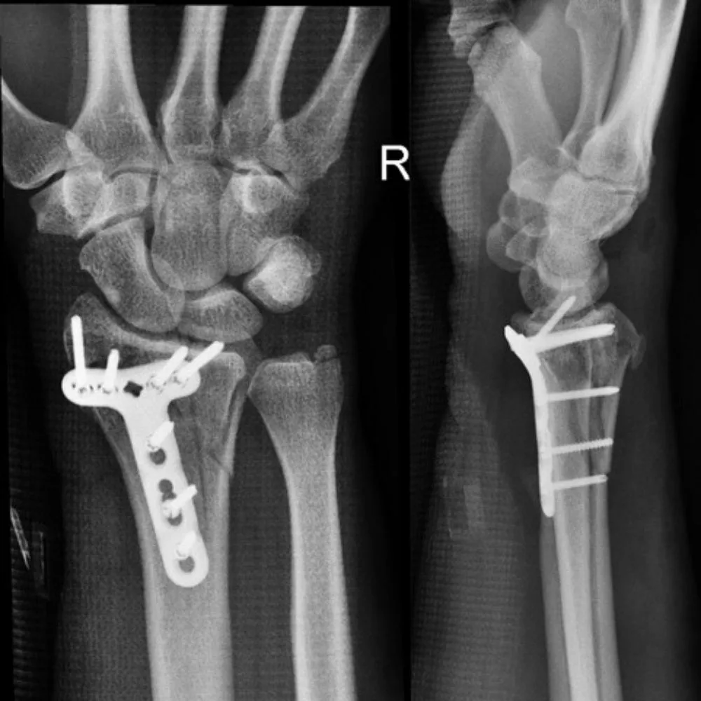 My wrist needed steel plates.