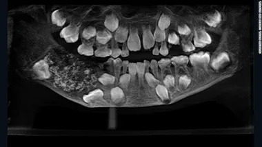 Medical shock: Doctors discover boy had 526 TEETH!
