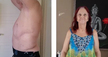 Surgery shock – ‘My nipples fell off!’