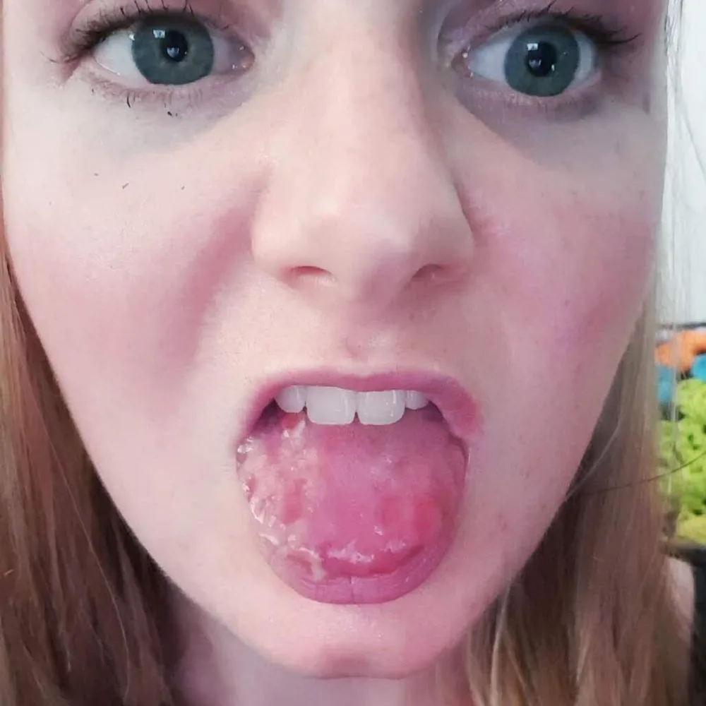 Caitlin became worried when her tongue started to swell. Credit: Supplied