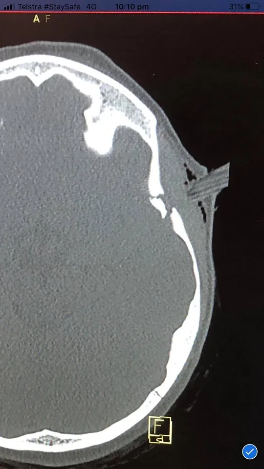 A scan showing the depth of the injury.