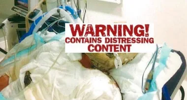 Campfire warning – ‘I became a human fireball’
