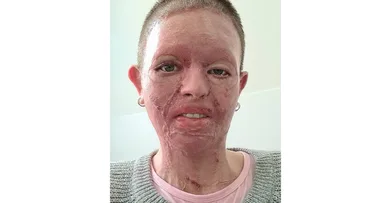 Camping horror – I woke up with my face on fire