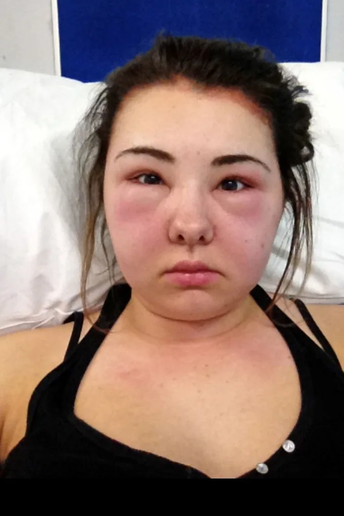 The swelling finally went down in hospital.