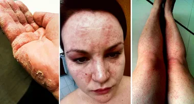 Scarred for life by wet wipes