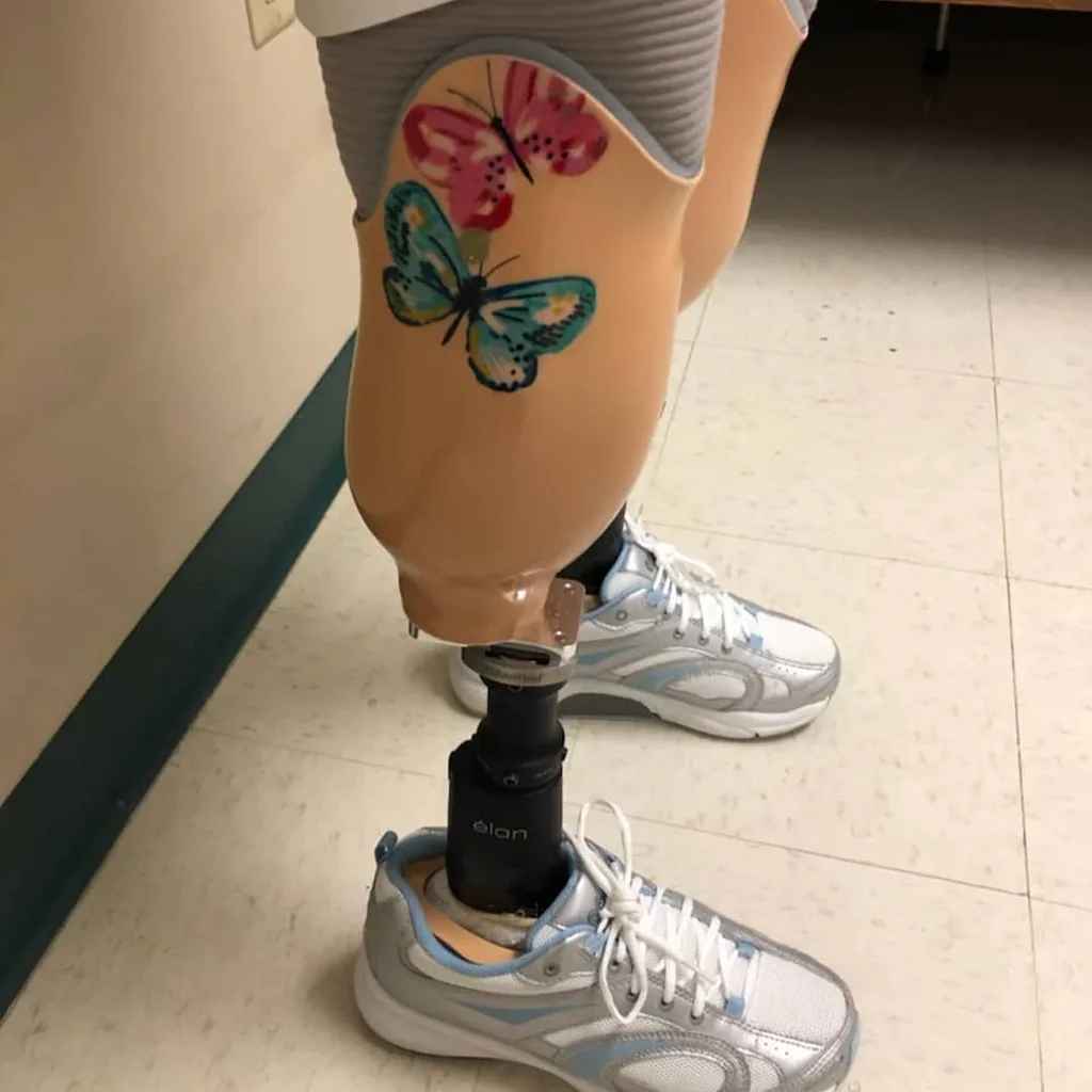 I had to learn to walk again on my prosthetic legs