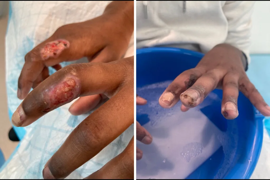 Mum's warning after daughter burnt by electric fan